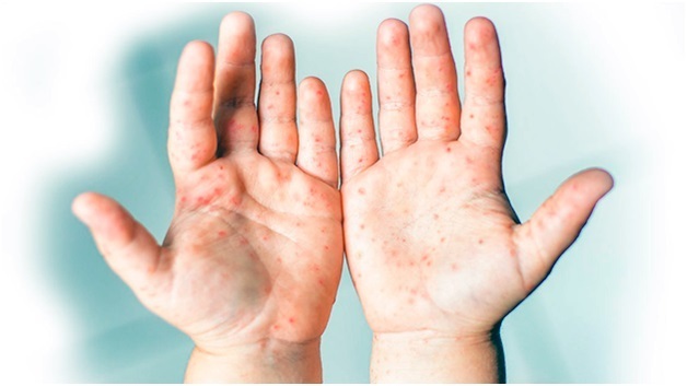 Профилактика энтеровирусной инфекции 