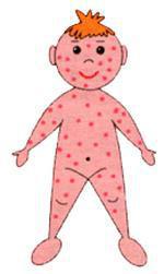 Эпидемиологическая ситуация и меры профилактики заболеваний корью