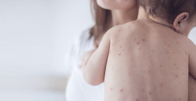 Профилактика кори.