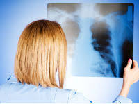 О профилактике внебольничных пневмоний